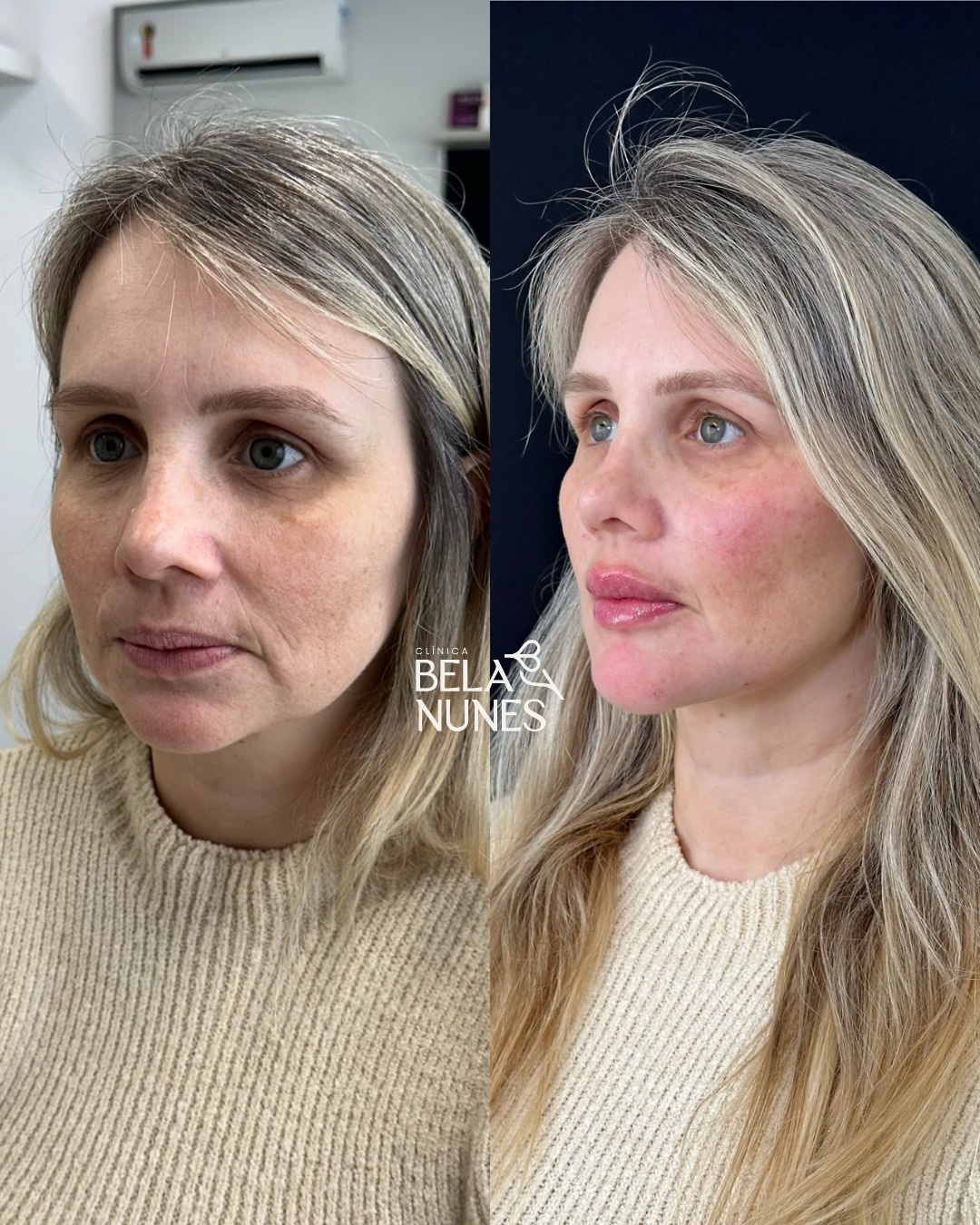 Resultado 4: antes e depois