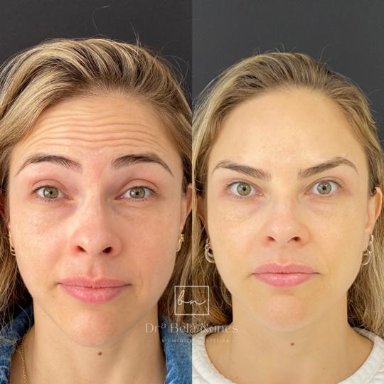 Resultado 18: antes e depois